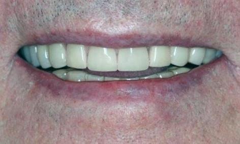 Crowns-Bridge-and-Implants-After-Image