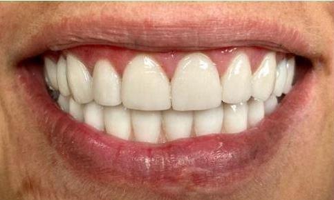 Implants-Veneers-and-Crowns-After-Image