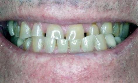 Crowns-Bridge-and-Implants-Before-Image