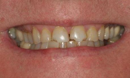 Crowns-Before-Image