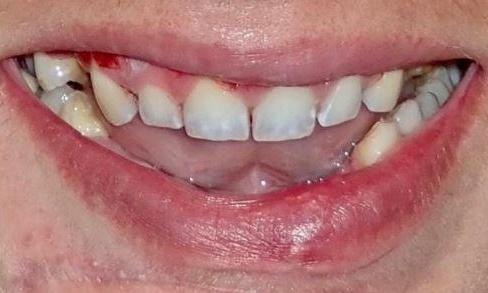 Implants-Veneers-and-Crowns-Before-Image